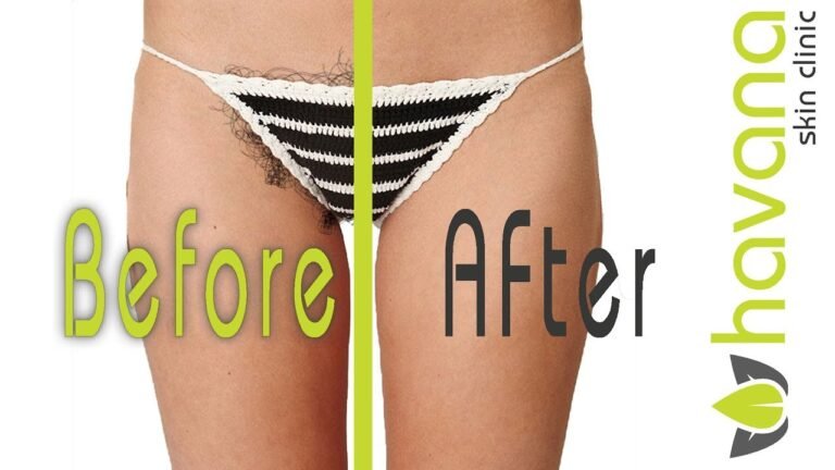 Before and After: Female Pubic Hair Laser Removal Results